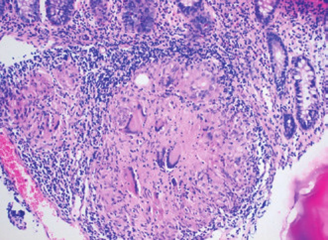 Histologický obraz krypt sliznice tlustého střeva, pod kterými je patrný granulom složený z epiteloidních buněk a mnohojaderných histiocytů. Kaseózní nekróza zachycena není (barvení hematoxylin-eozin, Patologie Litomyšl s. r. o.).
Fig. 3. Histological image of the colon mucomembranous crypts, with granuloma containing epitheliolid cells and multinucleated histiocytes. Caseous necrosis is not present (hematoxylin- -eosin staining, Department of Pathology, Litomysl s. r. o.).