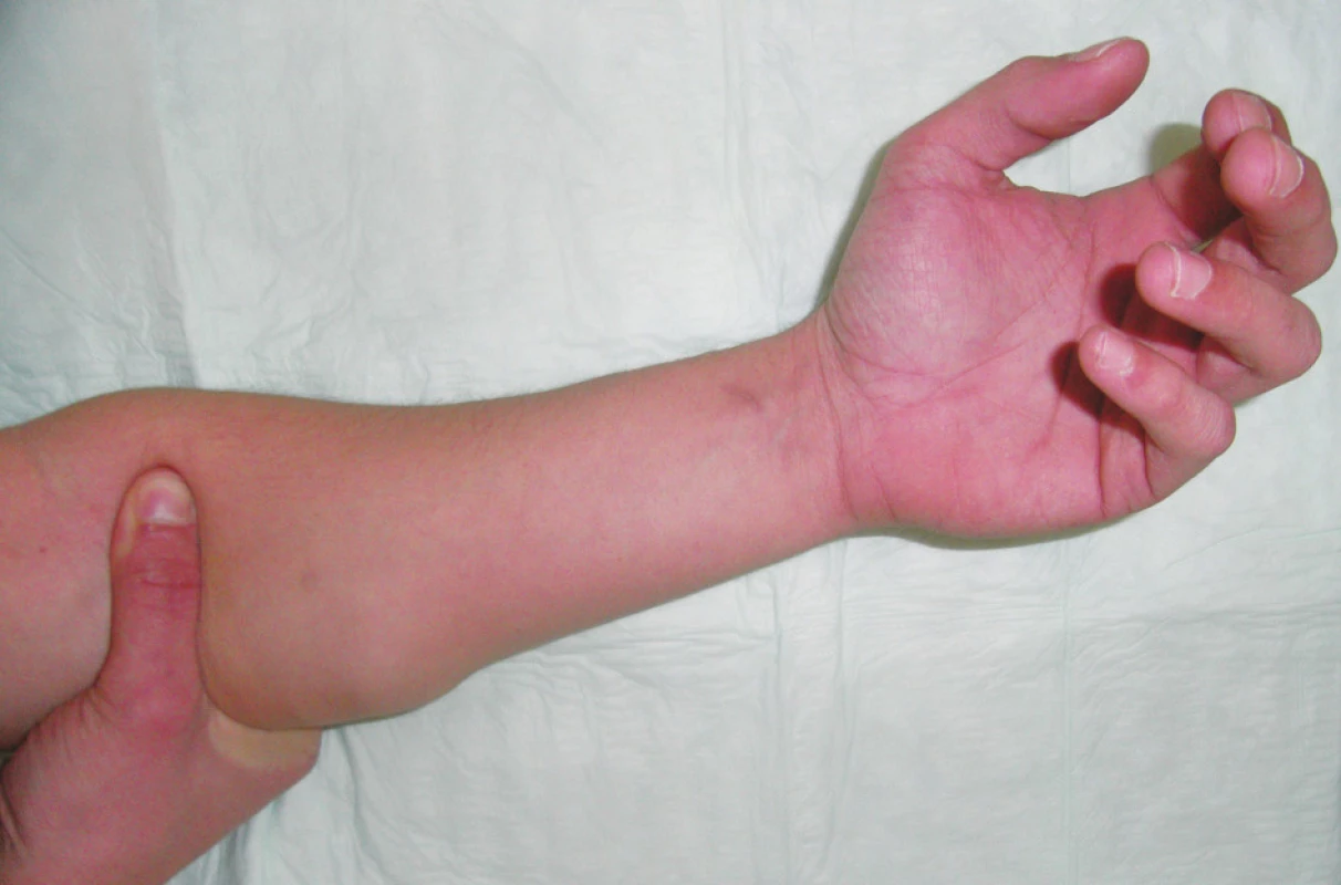 Natívny pohľad na herniu predlaktia
Fig. 1. Native view of the forearm hernia