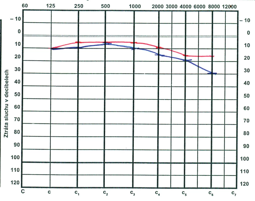 Normální tonoaudiogram