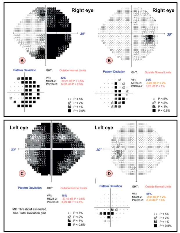 The results of the visual field examination with the 24-2 test strategy in the patient from the second case report over time.