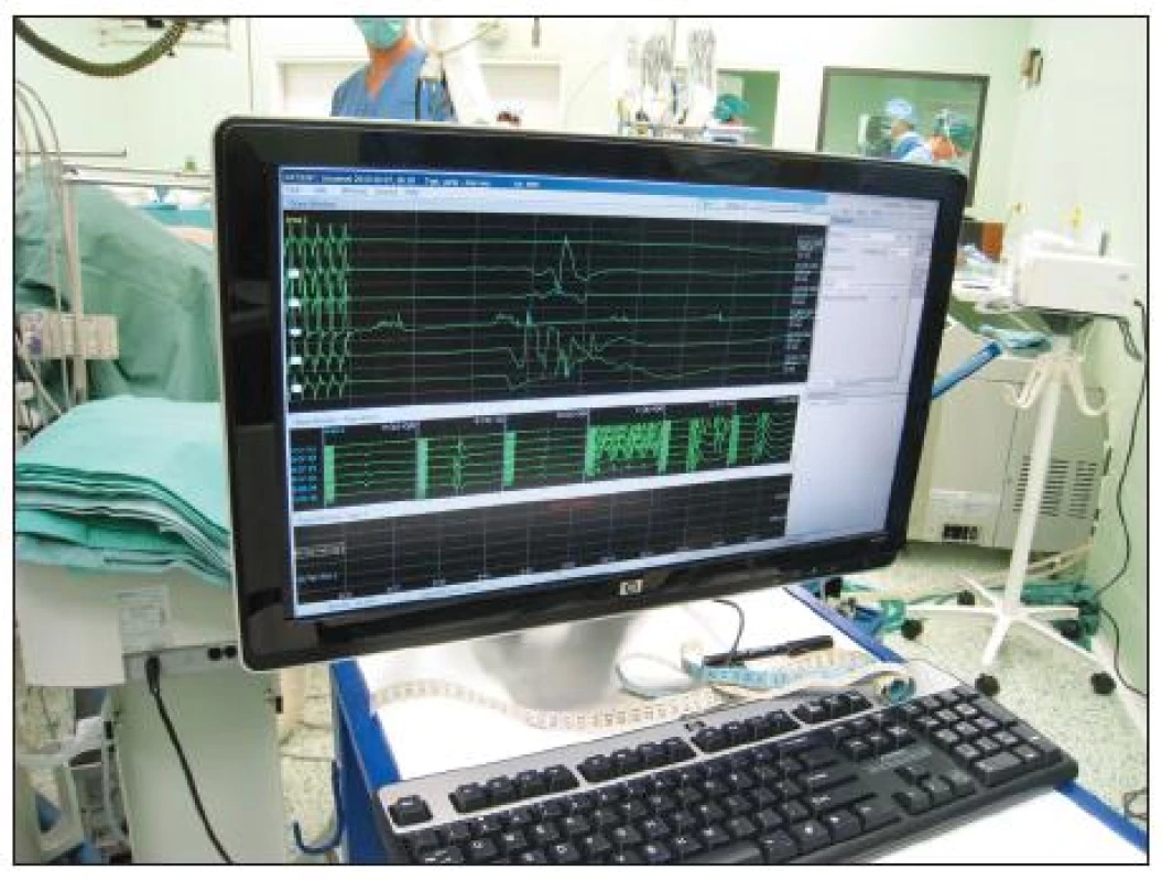 Neurologické peroperační sledování – peroperační foto
Fig. 5. Intraoperative neurological monitoring – intraoperative view