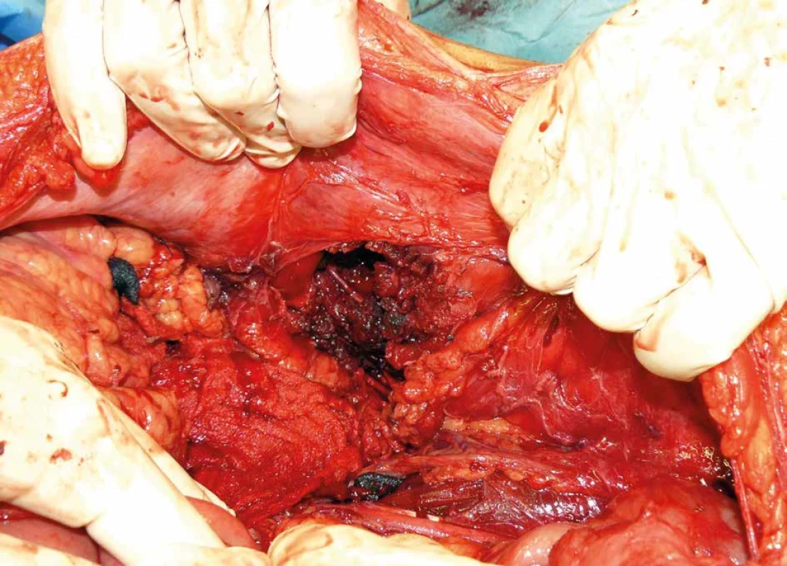 Pronikající střelné poranění břišní stěny   Fig. 1: Penetrating gunshot injury of the abdominal wall