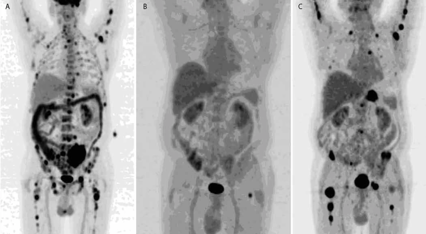 FDG PET /CT , MIP: therapy response monitoring.