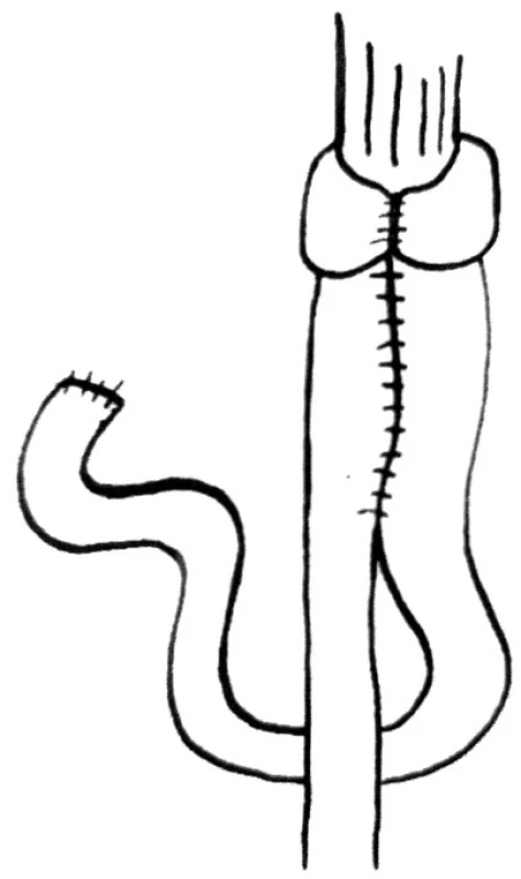 Rekontrukce Siewertova-Peiperova
Fig. 3. Siewert-Peiper reconstruction