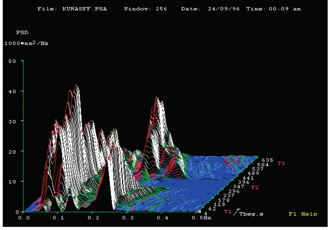 Ukázka 3D záznamu spektrální analýzy variability srdeční frekvence u zdravého člověka.