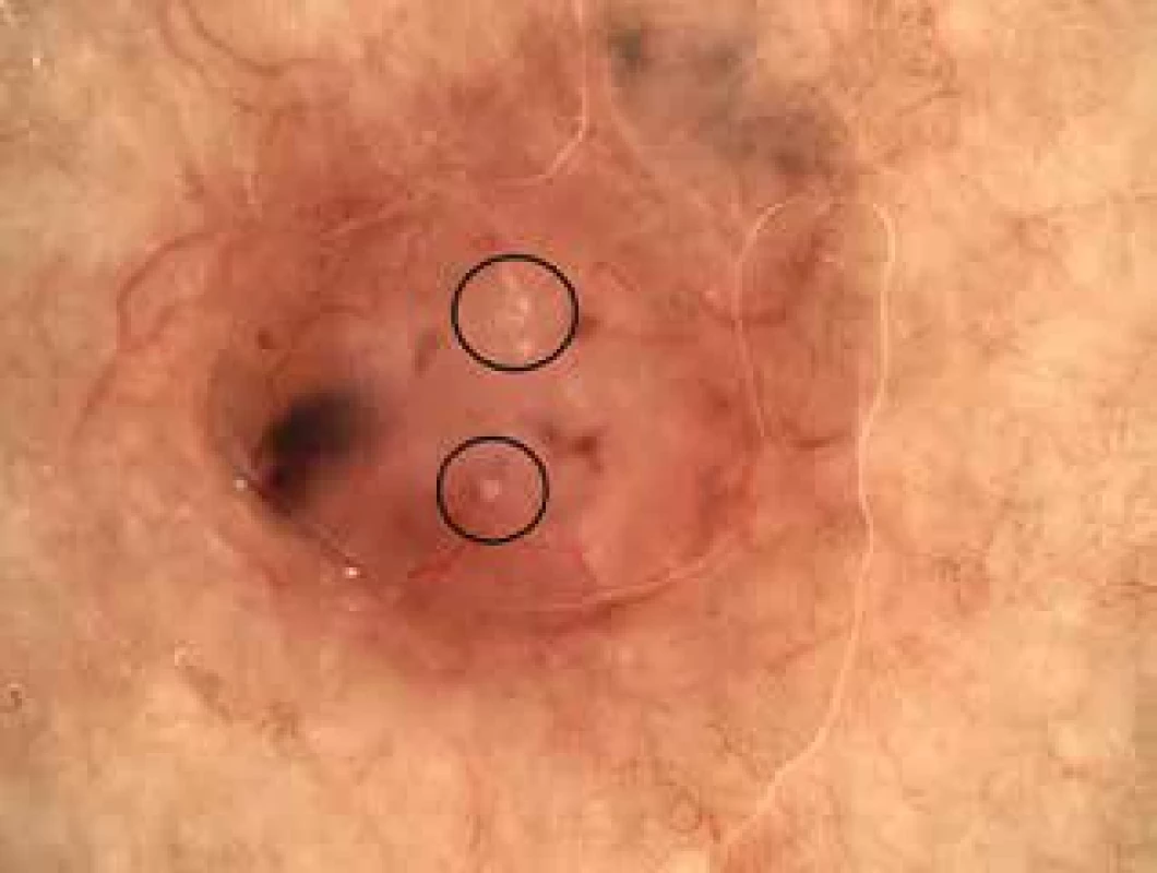 Dermatoskopický obraz nodulárního bazocelulárního karcinomu s přítomností dystrofické kalcifikace, označované jako tzv. MAY globules (černé kroužky)