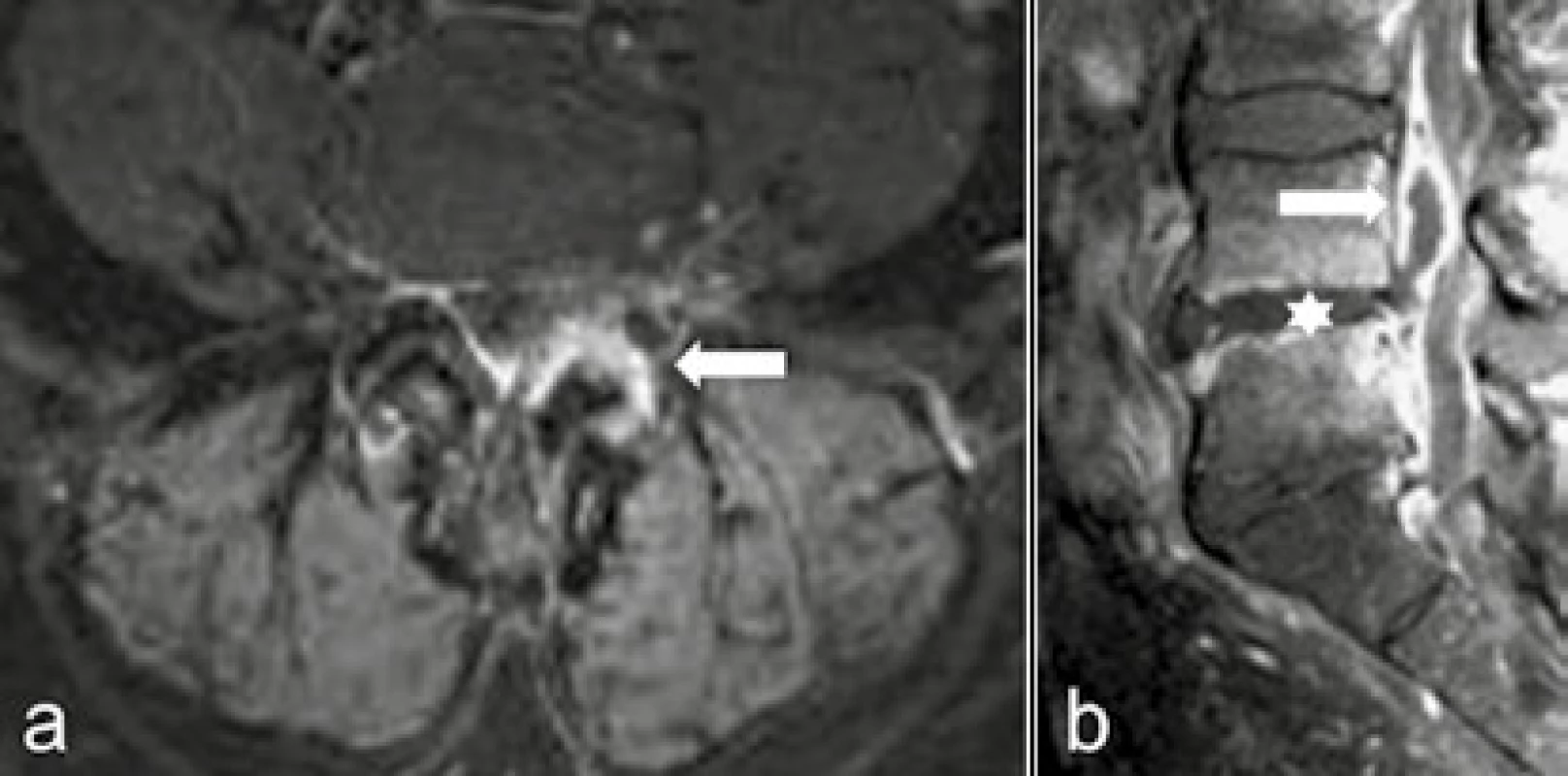 Septická artritida a spondylodiscitida
