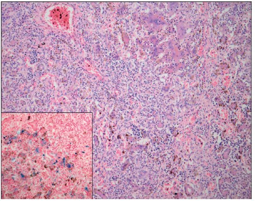 Játra – neonatální hemochromatóza (hematoxylin – eosin; Berlínská modř; zvětšení 100; hematopoéza, těžká dysplazie s neuspořádanými trabekulami, cholestáza, dilatace žlučovodů, mnohojaderné hepatocyty s těžkou siderózou).
Fig. 3. Liver – neonatal hemochromatosis (hematoxyline – eosine staining and Prussian blue
staining; magnification 100; hemopoesis, cholestatasis and severe dysplasia with trabecular desorganization and multinuclear hepatocytes with massive siderosis).