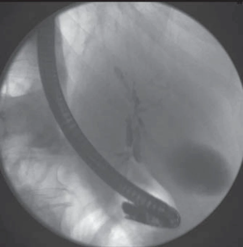 ERCP – stenóza distálního ductus choledochus, ductus hepaticus communis, četné stenózy intrahepatických žlučovodů s prestenotickými dilatacemi.
Fig.2. ERCP – stenosis of the common bile duct, common hepatic duct, multiple intrahepatic stenosis with corresponding pre-stenotic dilatations.