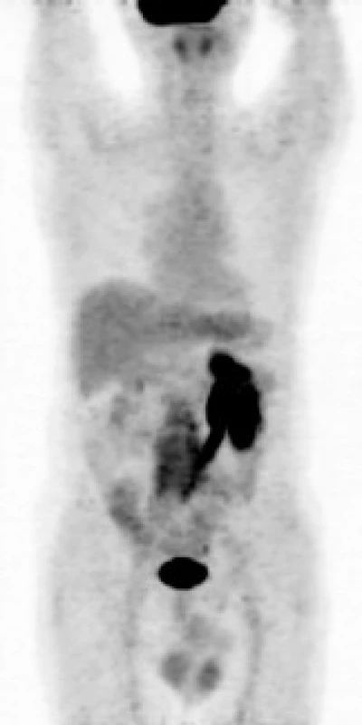 <sup>18</sup>F- FDG PET – MIP (maximum intesity projections) v barevné škále grayscale: ložisko patologického hypermetabolizmu glukózy (akumulace radiofarmaka <sup>18</sup>F- FDG) v retroperitoneu obkružující kaudální část břišní aorty a společné ilické tepny. Je patrné městnání aktivní moči při vylučování radiofarmaka v levé ledvině a levém ureteru.