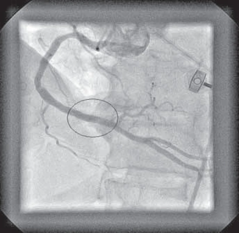 Pacient č. 1 – výsledný efekt po implantaci koronárního stentu.