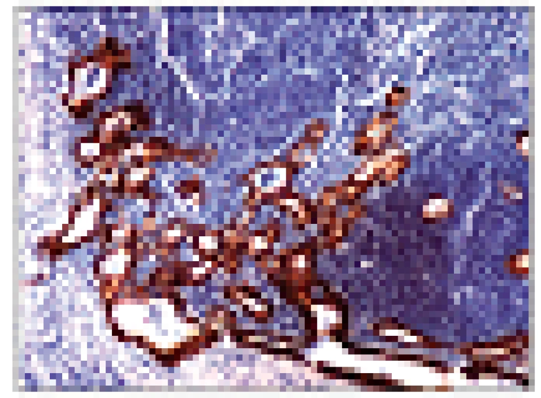 Histologický obraz (řez) metastázy obdobného nádoru s imunohistologickým průkazem cytokeratinů.