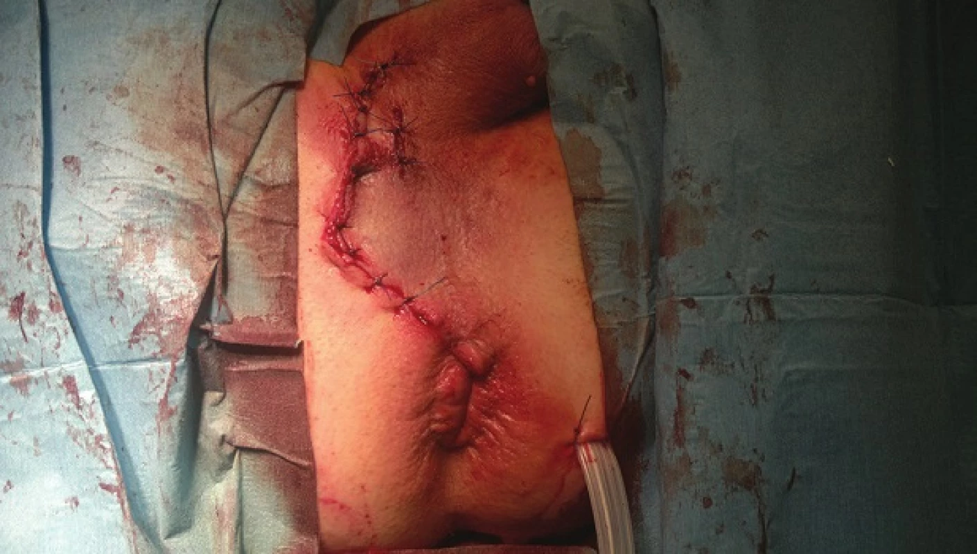 Stav na konci operace
Fig. 3: Situation at the end of the operation