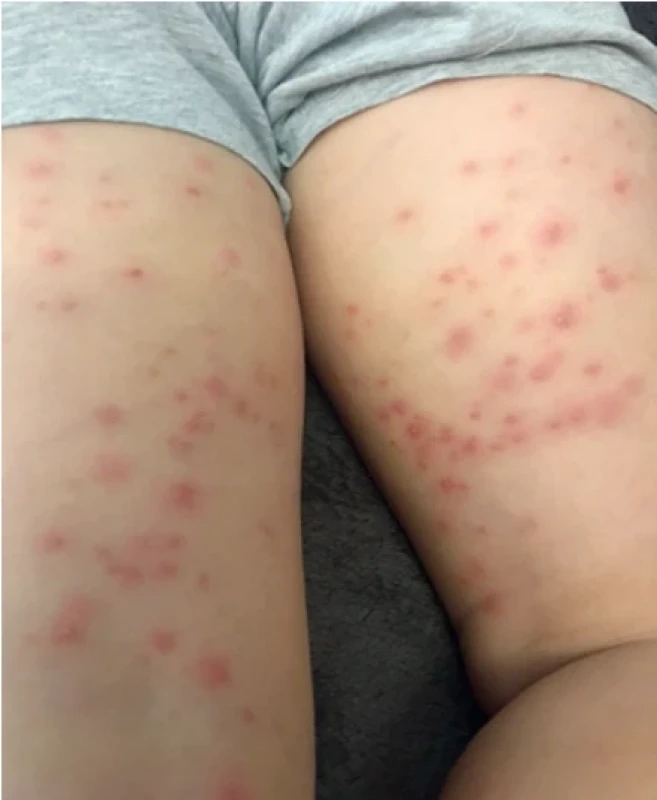 Hot tub folliculitis