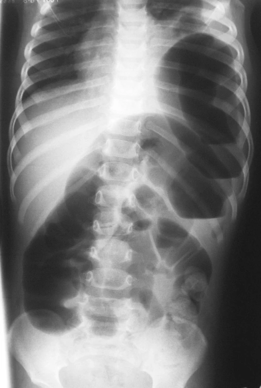 RTG hrudníka a brucha s ľavostrannou diafragmatickou herniou a ileóznym stavom
Fig. 4. Chest and abdominal x-ray views with a left-sided diaphragmatic hernia and ileus