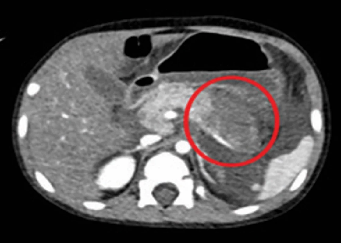  Nekrotizující zánět v oblasti těla a kaudy pankreatu. Fig.1 . Necrotizing infl ammation in the body and tail region  of the pancreas.