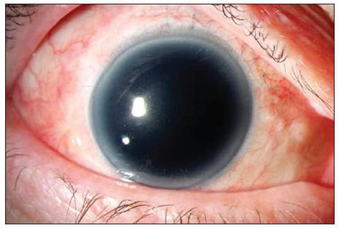 Nález před implantací modré PC IOL Ophtec
