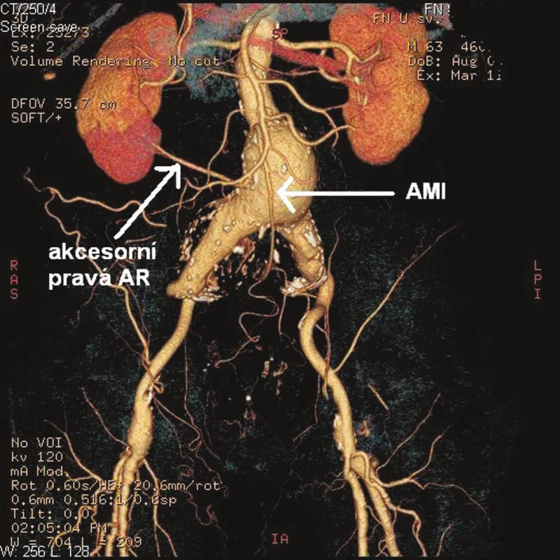 Předoperační CTA pacienta se zobrazením AMI a akcesorní pravé pólové renální tepny
Fig. 1. Preoperative CT angiography of the patient which demonstrates the accessory right renal artery and inferior mesenteric artery
