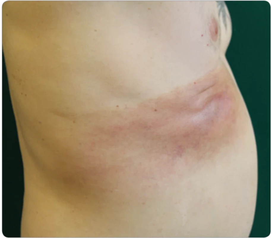 Pomalu se zvětšující hnědavý zvlněný plak barvy pomerančové slupky (peau d’orange) lokalizovaný nad plazmocytomem v žebru [45]. Nemoc diagnostikoval a léčil prof. Dr. Dan Lipsker ve Štrasburku. Autor popsal více podobných případů v odborné literatuře a pro časopis Klinická onkologie poskytl zatím nepublikovanou fotografi i kožního erytému u pacienta se AESOP syndromem.