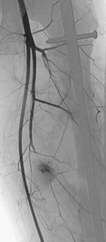 Angiografické zobrazení pseudoaneuryzmatu hluboké stehenní tepny – začátek plnění pseudoaneuryzmatu 
Pic. 3. Angiography of a deep femoral artery pseudoaneurysm – filling of the pseudoaneurysm