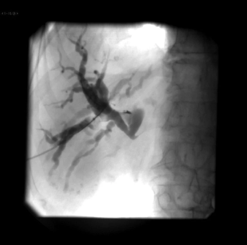 Komunikácia medzi žlčovým stromom a portálnou žilou vytvorená vodičom
Fig. 8: Communication between the biliary tree and the portal vein
