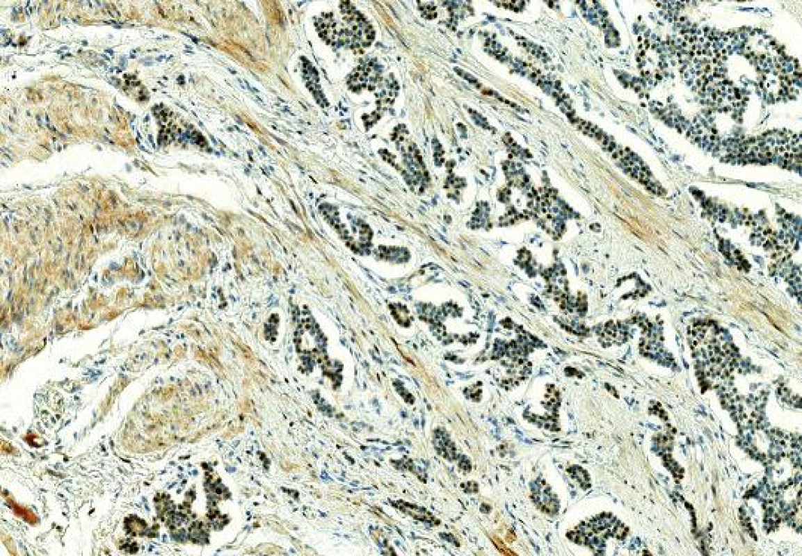 Imunohistochemický průkaz ER v NETu terminálního ilea, slabá až středně silná pozitivita (zvětšení 200x).