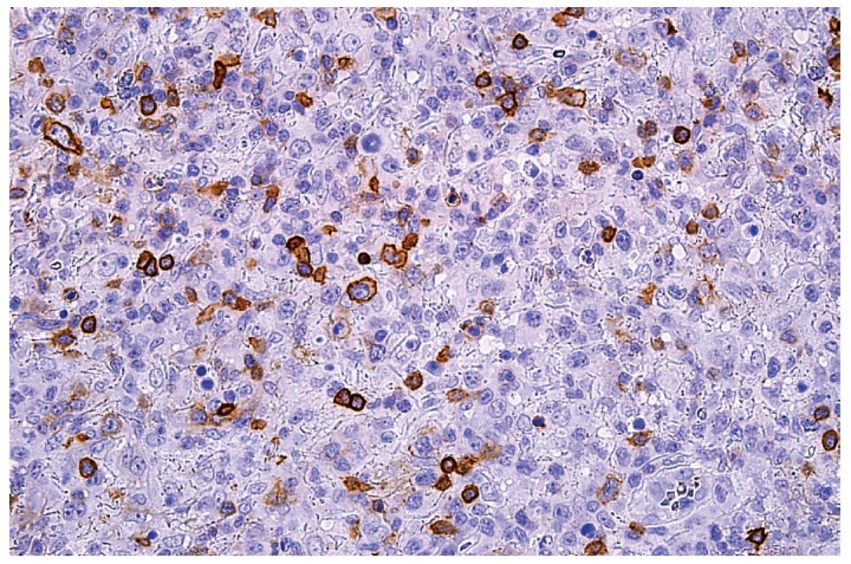 Molekula CD4 na buněčných membránách malých lymfocytů a roztroušených středně velkých plazmacytoidních monocytů. Imunohistochemická reakce, dobarveno hematoxylinem (zvetšení 200x).