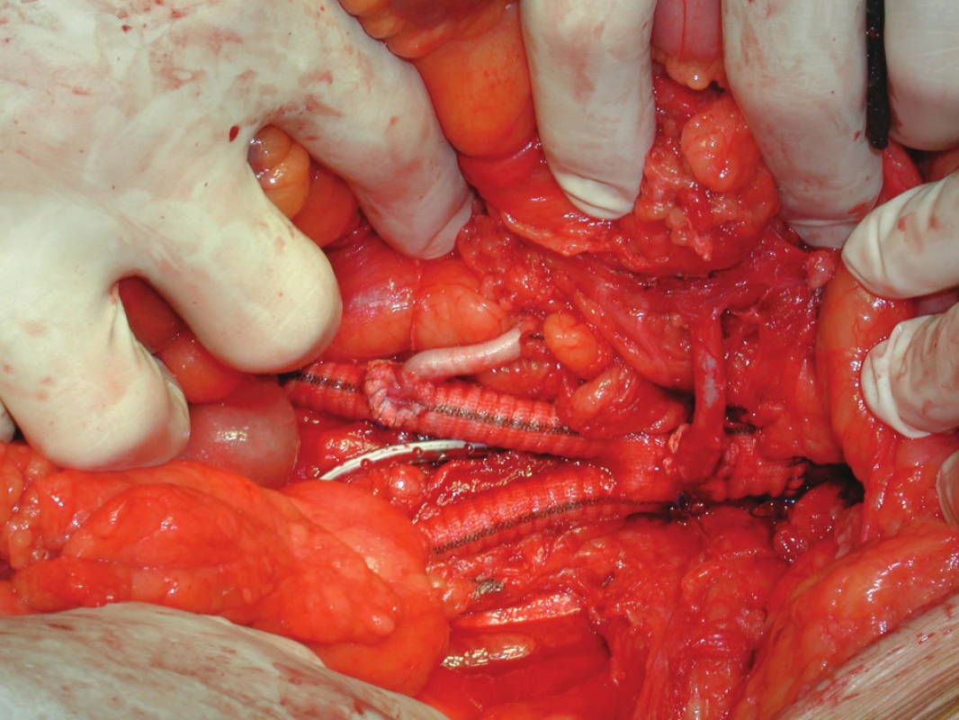 Peroperační snímek aorto-biillické protézy s reimplantovanou AMI a akcesorní pravou AR
Fig. 2. An intraoperative image showing bifurcated graft with reimplanted accessory right renal artery in the right limb of the graft and reimplanted IMA in the body of the graft