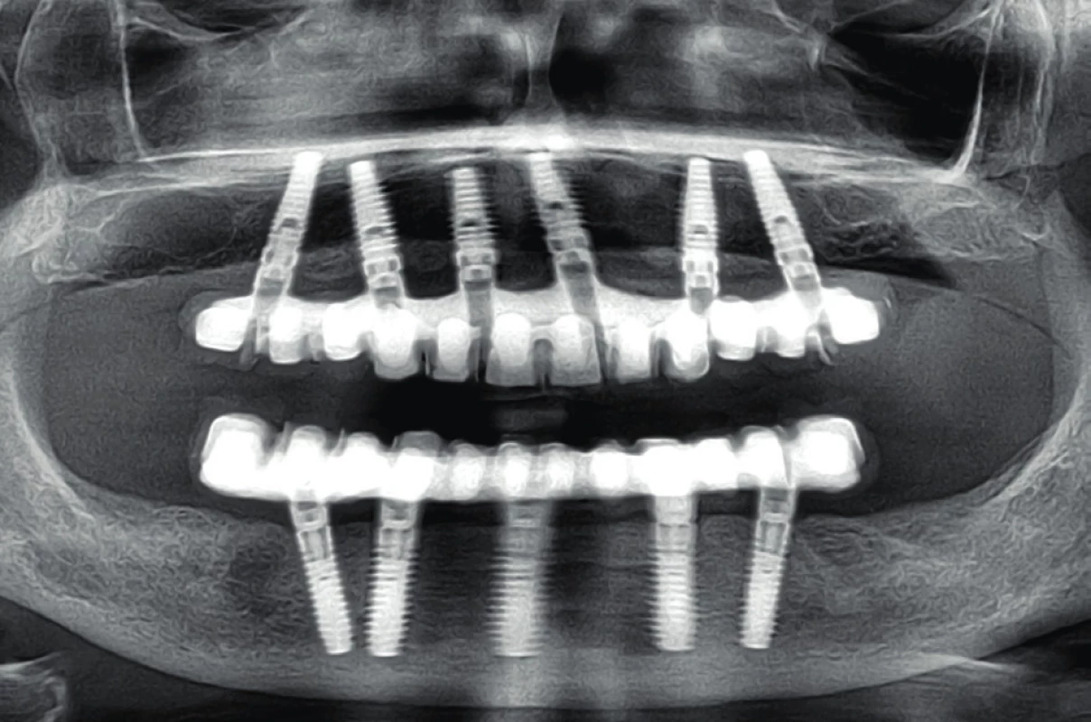 Disparalelní implantáty