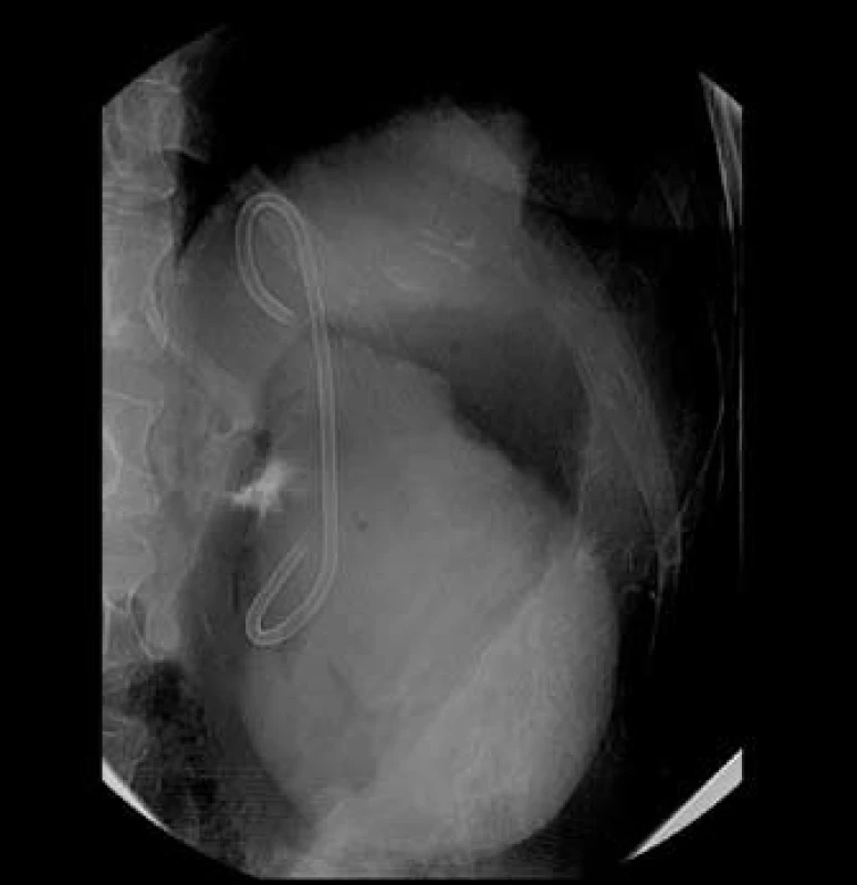 Drenáž cystoidu pod endosonografickou kontrolou.
Fig. 2. Cystoid drainage under endosonographic follow-up.