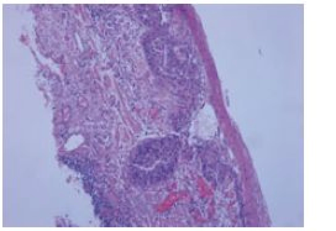 Histologický nález, barvení hematoxylin eozinem.
Fig. 3. Histological finding, haematoxylin- eosin staining.