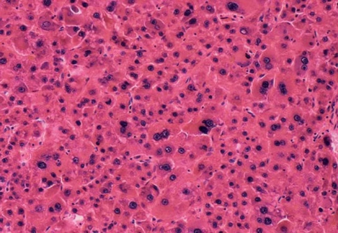 Histopatologický snímek dobře diferencovaného hepatocelulárního karcinomu (autor snímků – prof. J. Ehrmann, FN Olomouc).
Fig. 4. Histopathology image of a well-differentiated hepatocellular carcinoma (image by Professor J. Ehrmann, FN Olomouc).