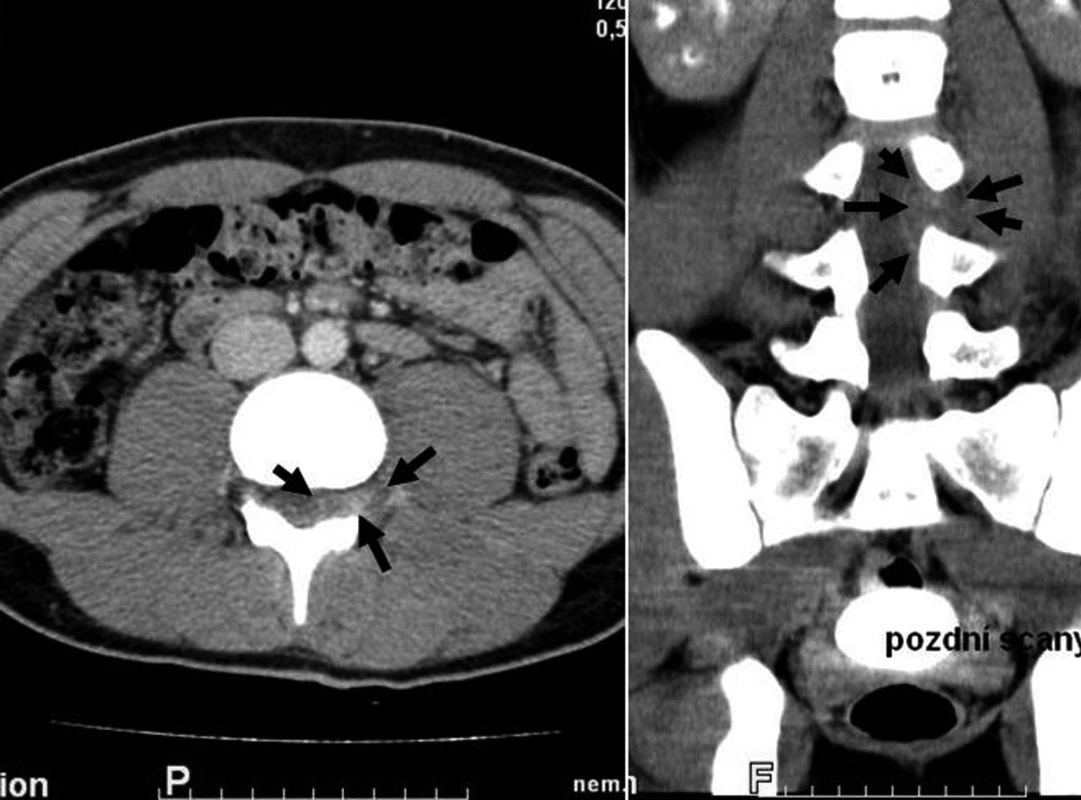 CT zobrazení: SEA v oblasti L3–4.
Fig. 1. CT imaging: SEA in region L3–4.