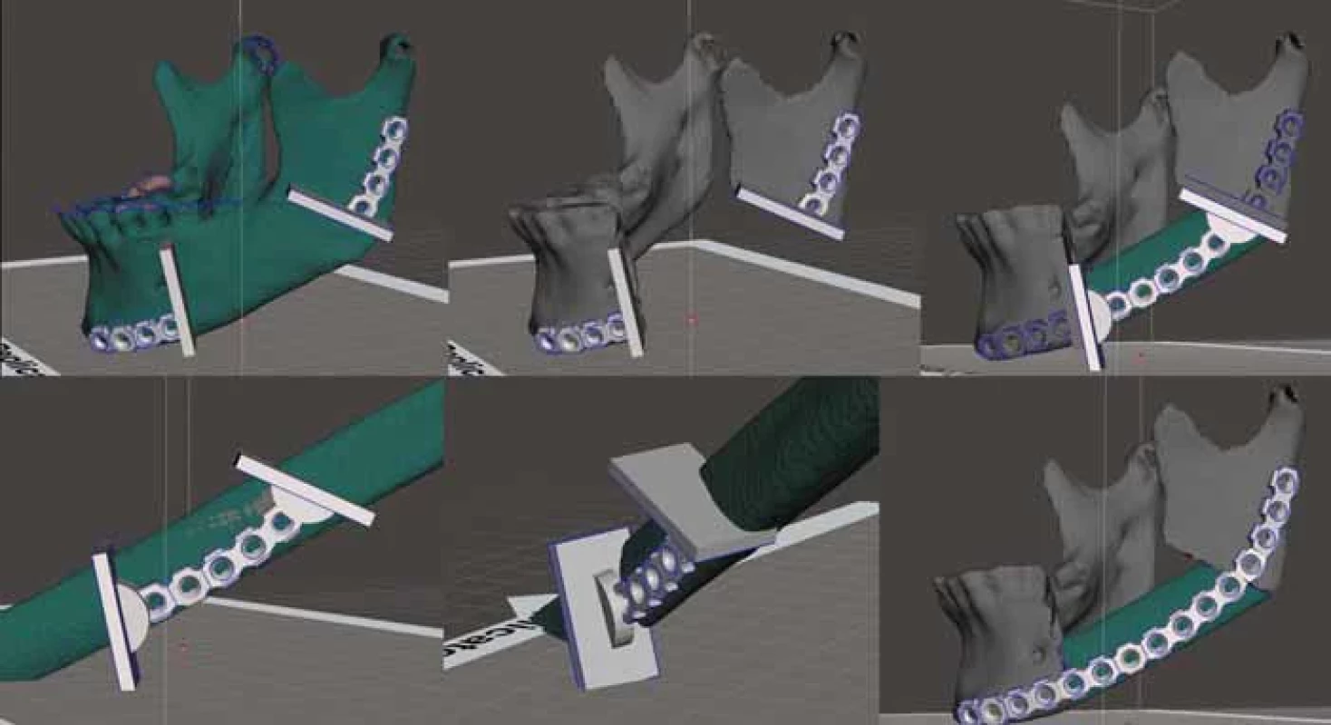 Process of VSP step by step-mandibular resection and fi bula free fl ap reconstruction; upper row