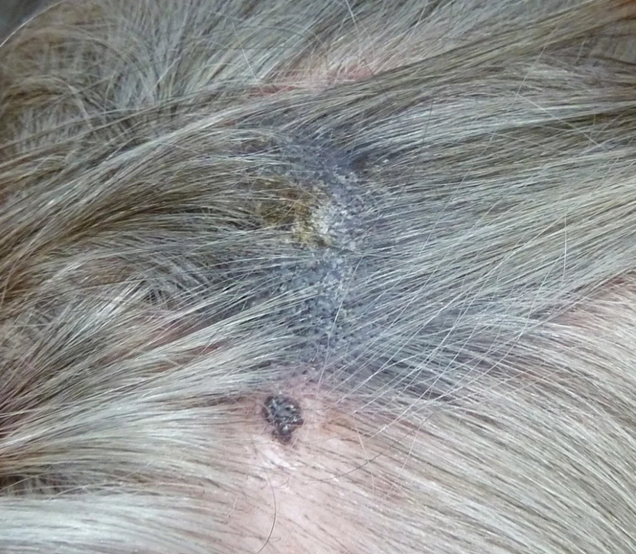 Maligní melanom kštice vzniklý na podkladě kongenitálního névu (Foto z archivu Dermatovenerologické kliniky FN Plzeň)
Fig. 6: Malignant melanoma of the scalp developed on the basis of a congenital naevus