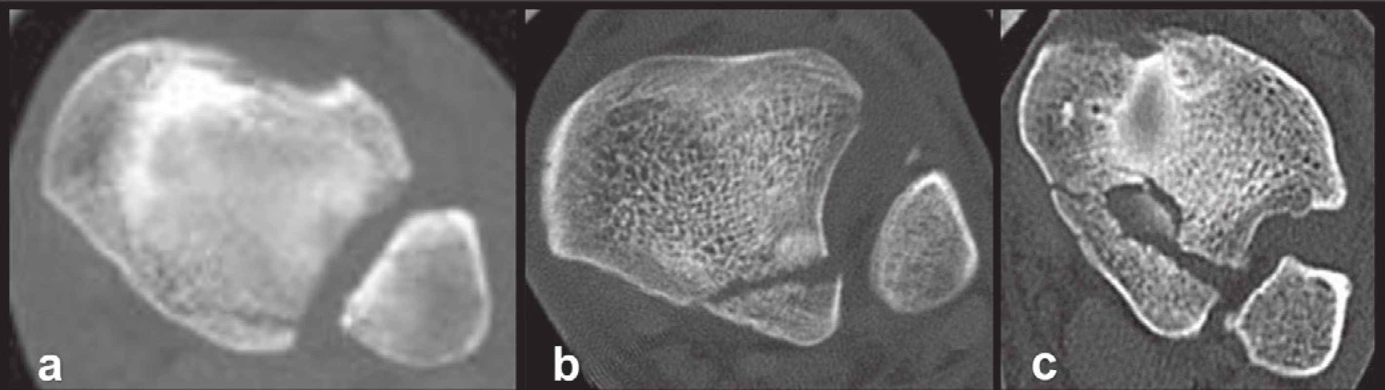 Variabilita typu 2 (posterolaterální fragment) na transverzálních CT řezech
a – malý fragment s minimálním postižením incisura fibularis tibiae, b – typický fragment s postižením jedné třetiny incisura fibularis tibie, c – velký fragment s patrným interkalárním fragmentem.
Fig. 12: Variability of type 2 (posterolateral fragment) on transversal CT scans
a – small fragment with minimal involvement of the fibular notch, b – typical fragment with involvement of one third of the fibular notch, c – large fragment with visible intercalary fragment.
