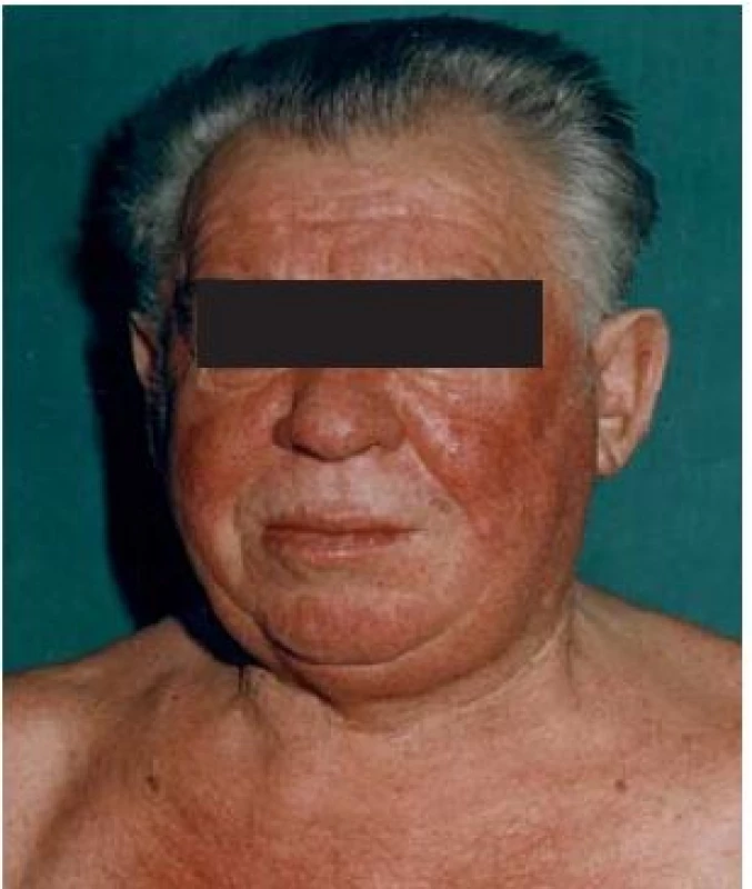 Patient with long-standing flush with rosacea development and hyperpigmentation at trigeminal dermatome and photoexposed areas. Patient was found to have generalised metastasis. Patient has been treated for rosacea.
Obr. 4. Pacient s dlhodobým flushom s vývojom rosacey a hyperpigmentá­ciou trigeminálneho dermatómu a slnku exponovaných plôch. Pacient pôvodne liečený na rosaceu bol diagnostikovaný s generalizovaným neuroendokrinným tumorom.