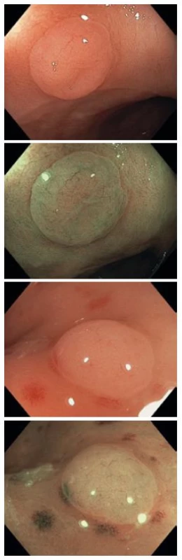 Diminutivní hyperplastické polypy v bílém světle a v NBI, kategorie NICE I.
Fig. 3. Diminutive hyperplastic polyps in white light and in NBI, NICE I category.