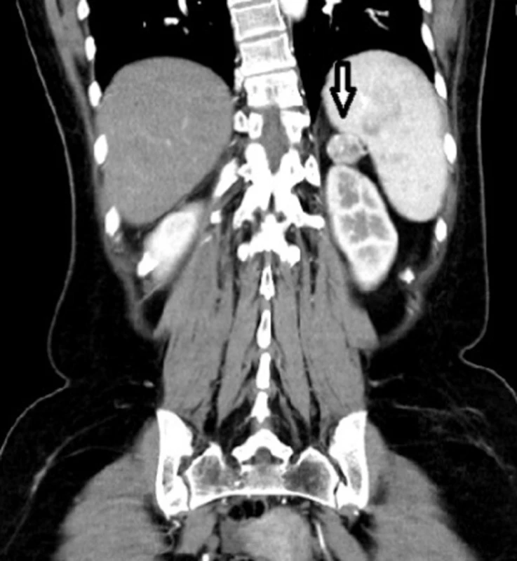 Léze v oblasti slezinného hilu
Fig. 2: Lesion in the splenic hilum