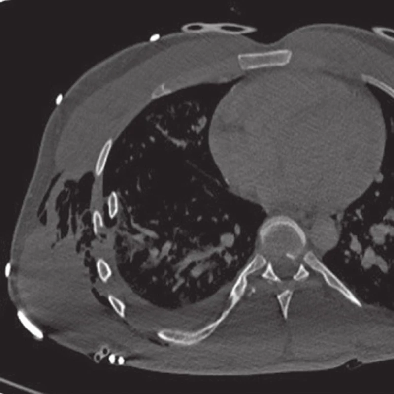 Laterální typ, perforace plíce
Fig. 4: Lung perforation