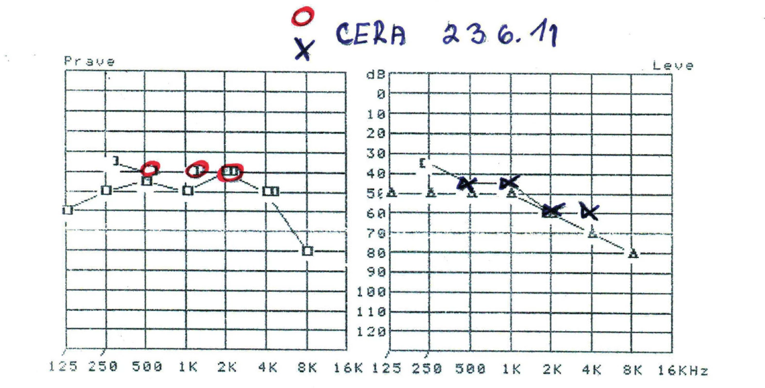 Tonoaudiogram se zaznamenanou senzorineurální poruchou sluchu