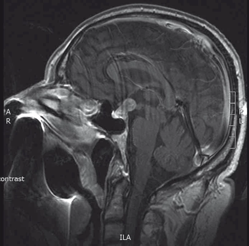 MRI hypofýzy (T1 vážené sagitální skeny s kontrastní látkou).
Patrná intra- a supraselární tumorózní expanze.
