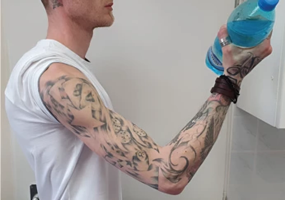 Follow-up visit of the patient 2 years after the procedure, muscle strength of the right upper limb was restoreda, the patient managed elbow fl exion against resistance (M ≥ 4).