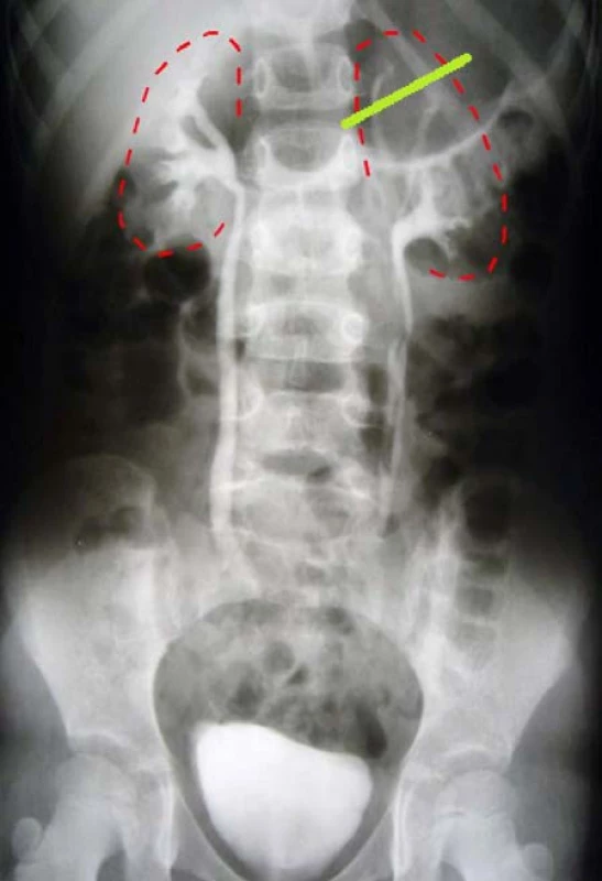 <i>Hemiureteronefrektómia horného segmentu obličky vľavo</i>
Fig. 7. <i>Hemiureteronephrectomy of the upper segment of the left kidney</i>