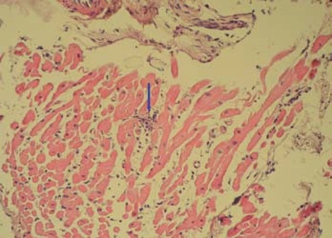 Bioptický vzorek myokardu (zvětšení 200×) s imunohistochemickým průkazem patologického (nadhraničního) infiltrátu LCA (Leukocyte Common Antigen) + leukocytů (označeny šipkou) v intersticiu.
Fig. 6. Bioptic sample of the myocardium (magnification of 200×) with immunohistochemical manifestation of the pathological (above-limit) infiltrate LCA (Leukocyte Common Antigen) + of leukocytes
(marked by arrow) in the interstitium.