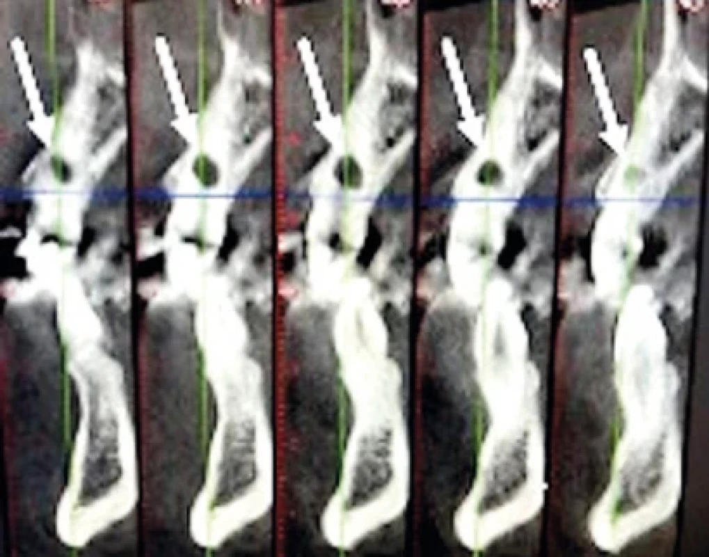 Séria CBCT rezov rekonštruovaných na zub 23. Zdroj: Simona Fritzká. Fig. 7 A series of CBCT slices reconstructed on tooth 23. Source: Simona Fritzká.