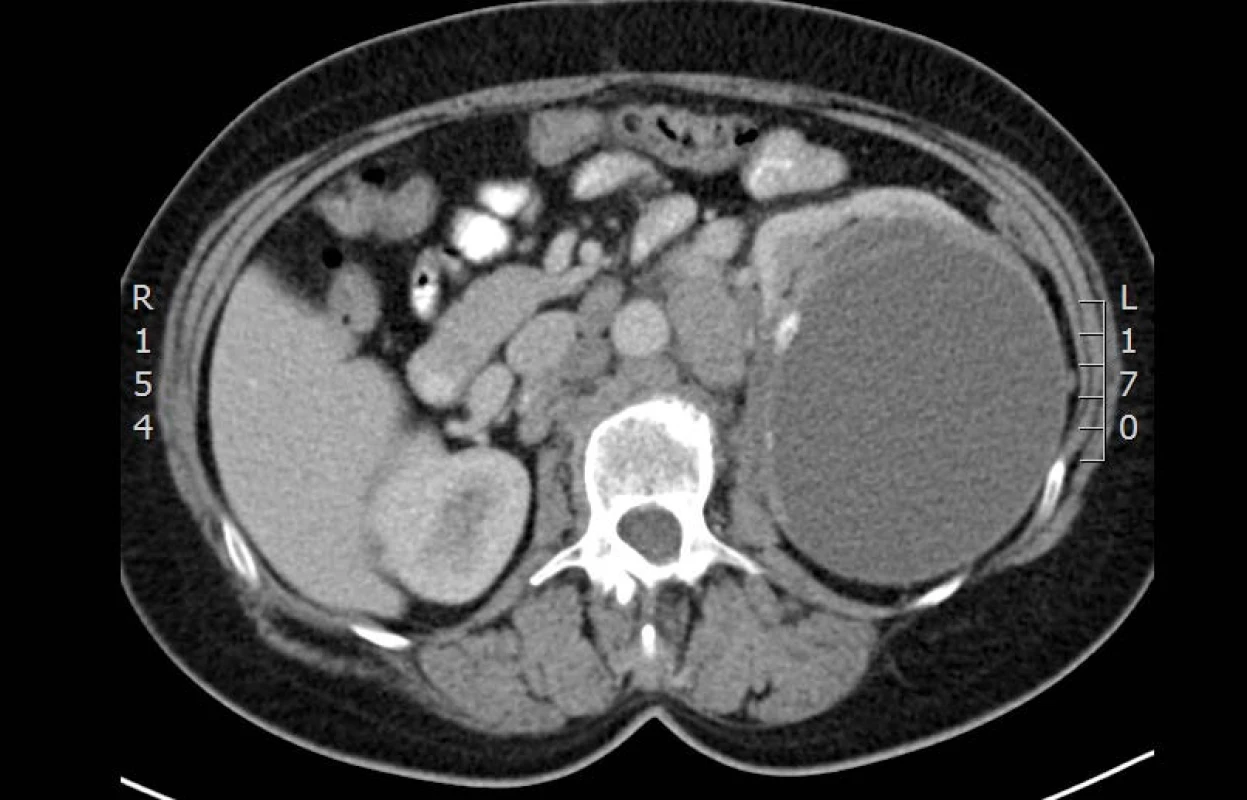CT vyšetření: cystický útvar v horním pólu ledviny – kraniální část
Fig. 1. CT: axial section at the level of cystic formation in the upper pole of kidney – cranial part