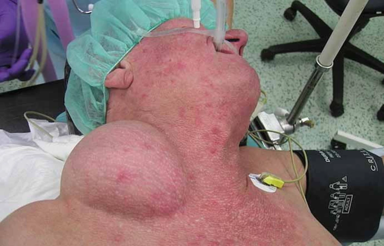 The physical findings presented a large tumor, approximately 15 × 20 cm in size.