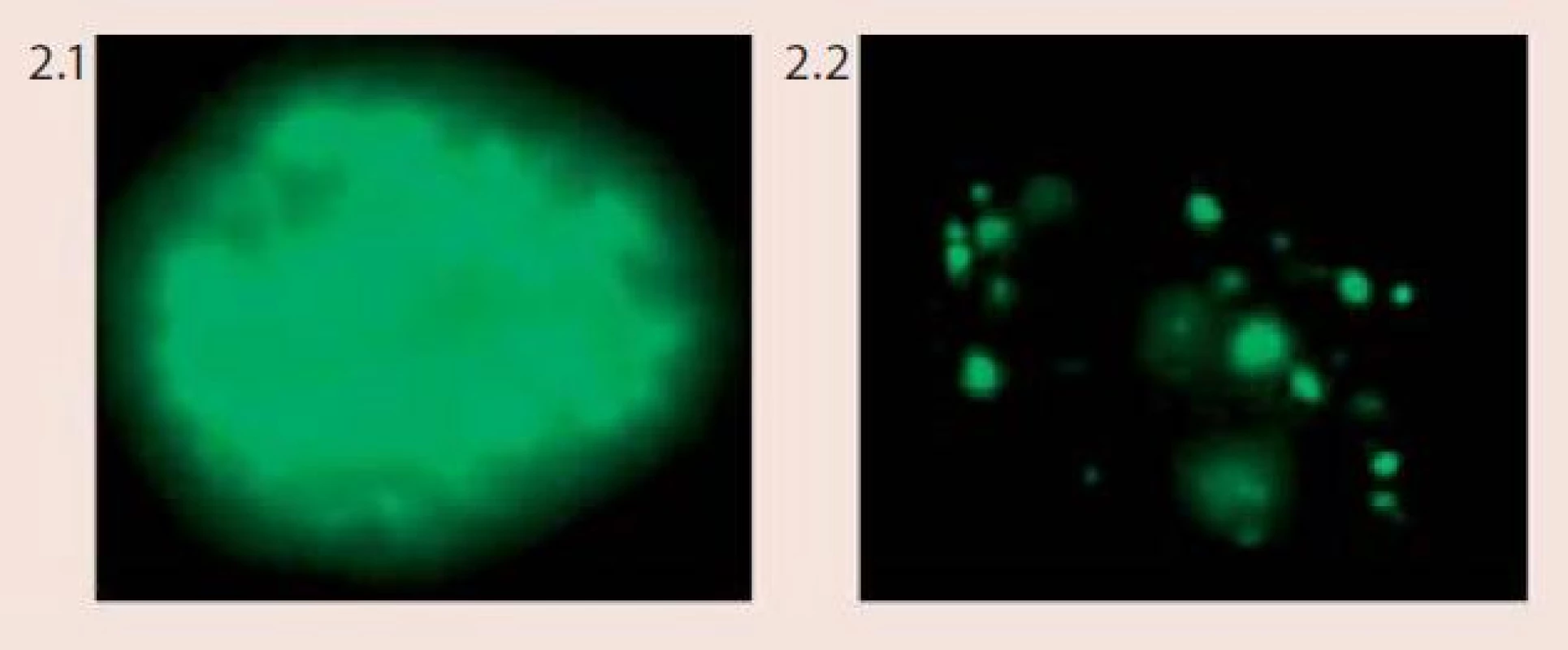 Vzor barvení buněk napadených lidským papilomavirem (HPV) při použití Vysis Cervical FISH Probe Kit (foto Laboratoř molekulární cytogenetiky ÚEB PřF Brno)
Obr. 2.1 Difuzní vzor barvení (epizomální status viru)
Obr. 2.2 Tečkovaný vzor barvení (integrovaný status viru)