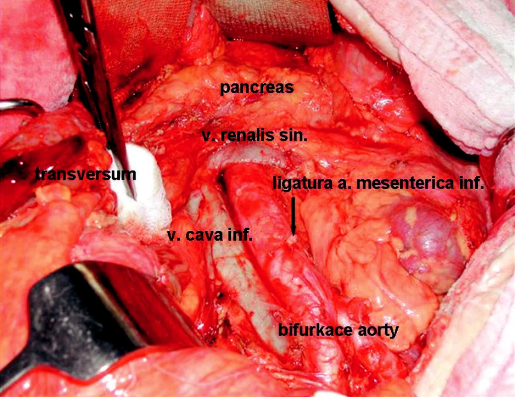 Stav po rozšířené levostranné hemikolektomii s radikální lymfadenektomií
Fig. 2. An operation field following extensive left-sided hemicolectomy with radical lymphadenectomy